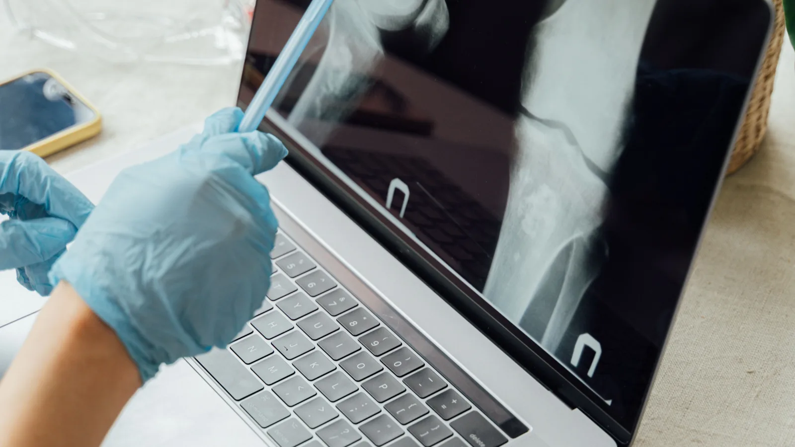 Osteopenie sau osteoporoză: cum citești rezultatul DEXA